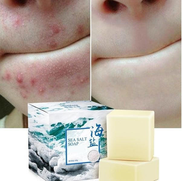 Mydełko z soli morskiej - Leczenie trądziku