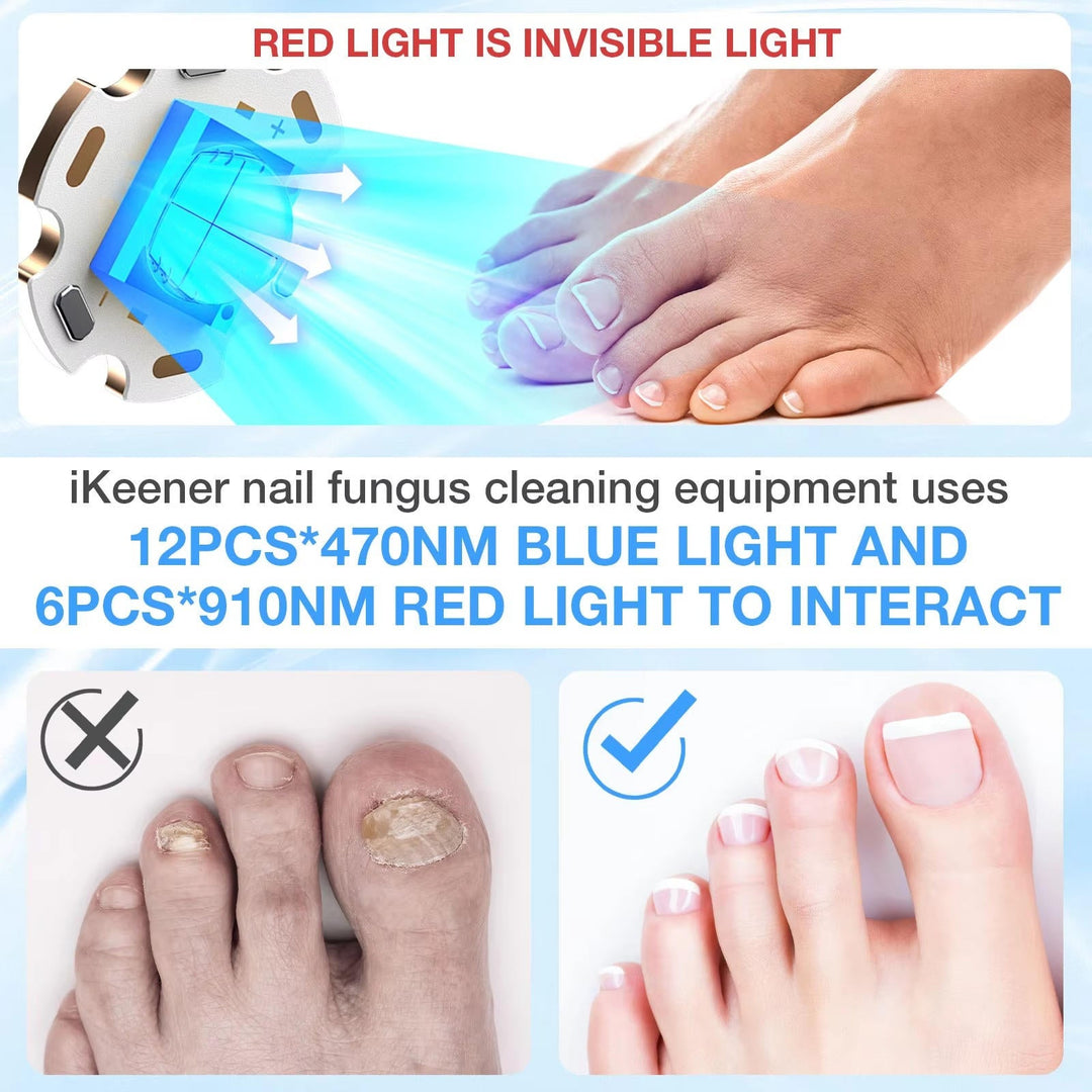 Laser na grzybicę paznokci